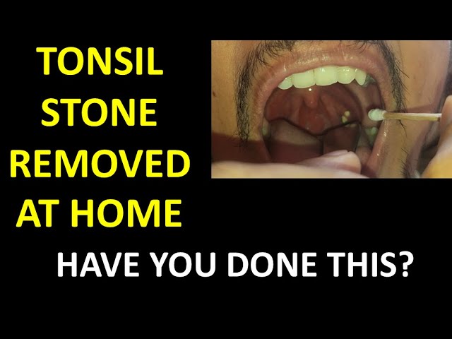 Managing Tonsil Stones Effectively