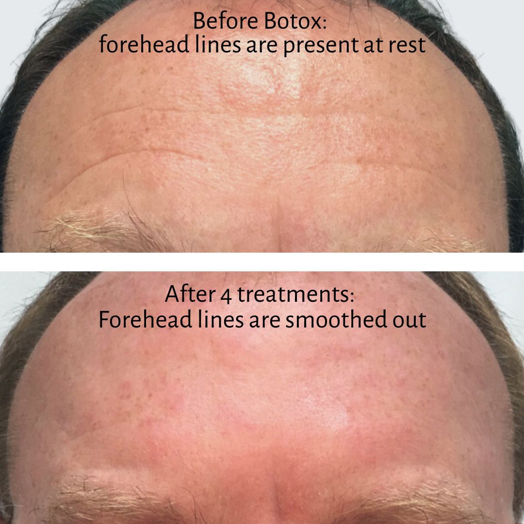 How to Get Rid of Forehead Wrinkles